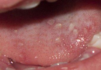 Chickenpox in children in the mouth and chickenpox in children on the tongue are easily curable today