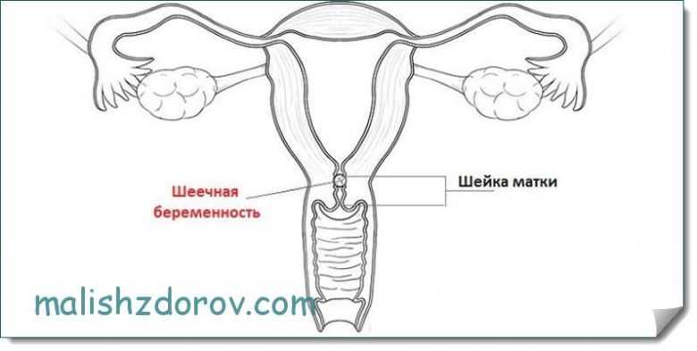 Внематочная беременность в шейке органа
