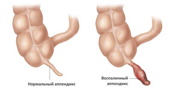 Inflammation of the appendix is ​​a possible cause of stomach pain in a child