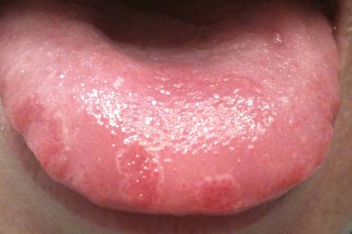 The appearance of wounds on the tongue of a child