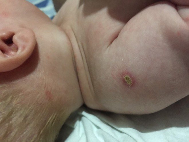 They squeezed out the pus at the site of the BCG vaccination, treated it with peroxide and smeared brilliant green