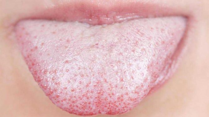 Ulcer on a child&#39;s tongue