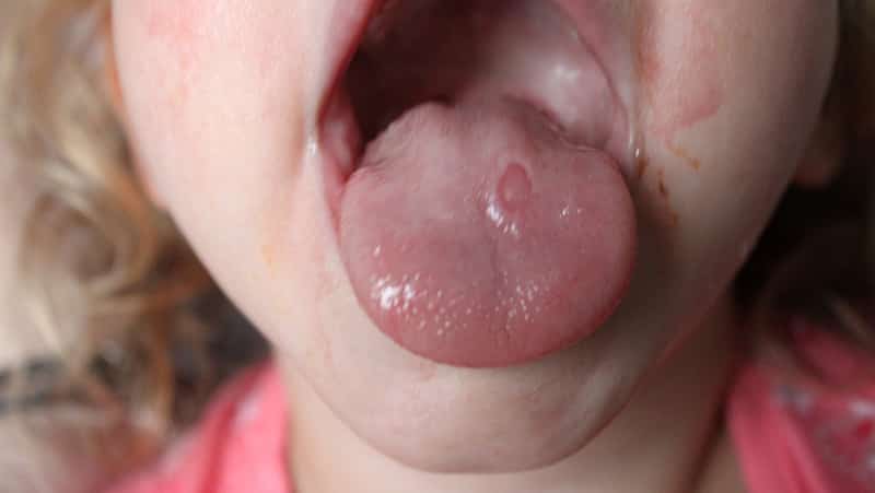 Ulcers on a child&#39;s tongue photo