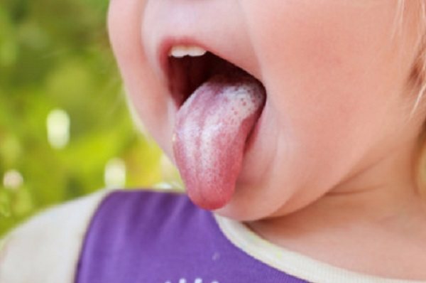 Child&#39;s tongue with white coating