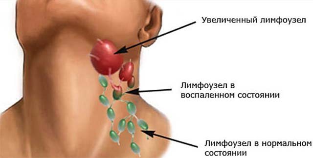 Healthy and inflamed lymph nodes
